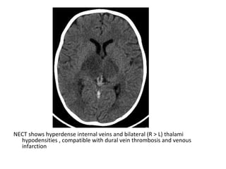 NECT shows hyperdense internal veins and bilateral (R > L) thalami
hypodensities , compatible with dural vein thrombosis and venous
infarction
 