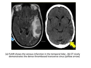 (a) FLAIR shows the venous infarction in the temporal lobe , (b) CT nicely
demonstrates the dense thrombosed transverse sinus (yellow arrow)
 