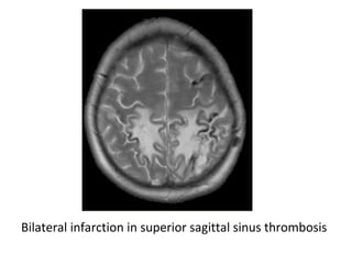 Bilateral infarction in superior sagittal sinus thrombosis
 
