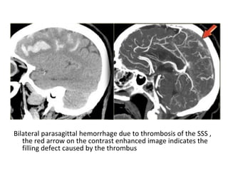 Bilateral parasagittal hemorrhage due to thrombosis of the SSS ,
the red arrow on the contrast enhanced image indicates the
filling defect caused by the thrombus
 