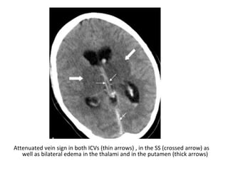 Attenuated vein sign in both ICVs (thin arrows) , in the SS (crossed arrow) as
well as bilateral edema in the thalami and in the putamen (thick arrows)
 
