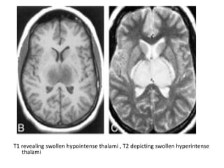 T1 revealing swollen hypointense thalami , T2 depicting swollen hyperintense
thalami
 