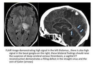 FLAIR image demonstrating high signal in the left thalamus , there is also high
signal in the basal ganglia on the right, these bilateral findings should raise
the suspicion of deep cerebral venous thrombosis, a sagittal CT
reconstruction demonstrates a filling defect in the straight sinus and the
vein of Galen (arrows)
 