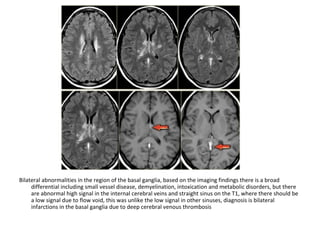 Bilateral abnormalities in the region of the basal ganglia, based on the imaging findings there is a broad
differential including small vessel disease, demyelination, intoxication and metabolic disorders, but there
are abnormal high signal in the internal cerebral veins and straight sinus on the T1, where there should be
a low signal due to flow void, this was unlike the low signal in other sinuses, diagnosis is bilateral
infarctions in the basal ganglia due to deep cerebral venous thrombosis
 
