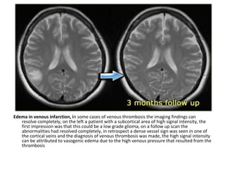 Edema in venous infarction, in some cases of venous thrombosis the imaging findings can
resolve completely, on the left a patient with a subcortical area of high signal intensity, the
first impression was that this could be a low grade glioma, on a follow up scan the
abnormalities had resolved completely, in retrospect a dense vessel sign was seen in one of
the cortical veins and the diagnosis of venous thrombosis was made, the high signal intensity
can be attributed to vasogenic edema due to the high venous pressure that resulted from the
thrombosis
 