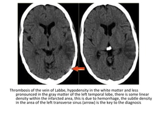 Thrombosis of the vein of Labbe, hypodensity in the white matter and less
pronounced in the gray matter of the left temporal lobe, there is some linear
density within the infarcted area, this is due to hemorrhage, the subtle density
in the area of the left transverse sinus (arrow) is the key to the diagnosis
 
