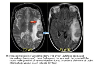 There is a combination of vasogenic edema (red arrow) , cytotoxic edema and
hemorrhage (blue arrow) , these findings and the location in the temporal lobe
should make you think of venous infarction due to thrombosis of the vein of Labbe
(Hemorrhagic venous infarct in Labbe territory)
 