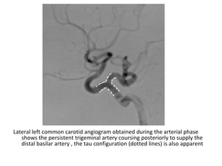 Lateral left common carotid angiogram obtained during the arterial phase
shows the persistent trigeminal artery coursing posteriorly to supply the
distal basilar artery , the tau configuration (dotted lines) is also apparent
 