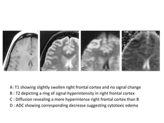 A: T1 showing slightly swollen right frontal cortex and no signal change
B : T2 depicting a ring of signal hyperintensity in right frontal cortex
C : Diffusion revealing a more hyperintense right frontal cortex than B
D : ADC showing corresponding decrease suggesting cytotoxic edema
 