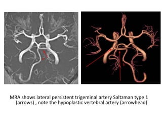 MRA shows lateral persistent trigeminal artery Saltzman type 1
(arrows) , note the hypoplastic vertebral artery (arrowhead)
 