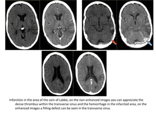 Infarction in the area of the vein of Labbe, on the non-enhanced images you can appreciate the
dense thrombus within the transverse sinus and the hemorrhage in the infarcted area, on the
enhanced images a filling defect can be seen in the transverse sinus
 