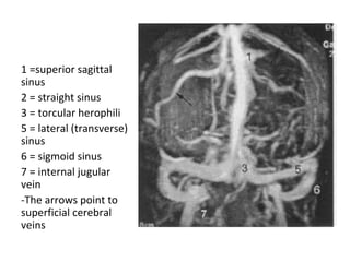 1 =superior sagittal
sinus
2 = straight sinus
3 = torcular herophili
5 = lateral (transverse)
sinus
6 = sigmoid sinus
7 = internal jugular
vein
-The arrows point to
superficial cerebral
veins
 