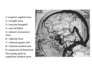 1 =superior sagittal sinus
2 = straight sinus
3 = torcular herophili
4 = vein of Galen
5 = lateral ( transverse )
sinus
6 = sigmoid sinus
7 = internal jugular vein
8 = internal cerebral vein
9 = basal vein of Rosenthal
The arrows point to
superficial cerebral veins
 