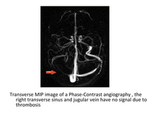 Transverse MIP image of a Phase-Contrast angiography , the
right transverse sinus and jugular vein have no signal due to
thrombosis
 
