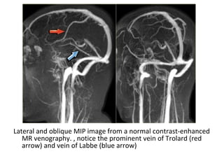 Lateral and oblique MIP image from a normal contrast-enhanced
MR venography. , notice the prominent vein of Trolard (red
arrow) and vein of Labbe (blue arrow)
 