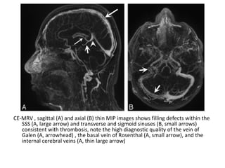 CE-MRV , sagittal (A) and axial (B) thin MIP images shows filling defects within the
SSS (A, large arrow) and transverse and sigmoid sinuses (B, small arrows)
consistent with thrombosis, note the high diagnostic quality of the vein of
Galen (A, arrowhead) , the basal vein of Rosenthal (A, small arrow), and the
internal cerebral veins (A, thin large arrow)
 