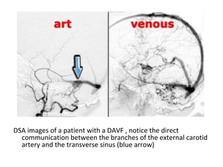 DSA images of a patient with a DAVF , notice the direct
communication between the branches of the external carotid
artery and the transverse sinus (blue arrow)
 