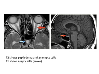 T2 shows papiledema and an empty sella
T1 shows empty sella (arrow)
 