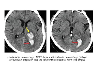 Hypertensive hemorrhage , NECT show a left thalamic hemorrhage (yellow
arrow) with extension into the left ventricle occipital horn (red arrow)
 