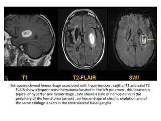 -Intraparenchymal hemorrhage associated with hypertension , sagittal T1 and axial T2
FLAIR show a hyperintense hematoma located in the left putamen , this location is
typical of hypertensive hemorrhage , SWI shows a halo of hemosiderin in the
periphery of the hematoma (arrow) , an hemorrhage of chronic evolution and of
the same etiology is seen in the contralateral basal ganglia
 