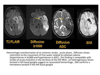 -Hemorrhagic transformation of an ischemic stroke , acute phase , Diffusion shows
restriction to the movement of free water related to cytotoxic edema
(hyperintense in b1000 and hypointense in ADC) , this finding is compatible with
stroke of acute evolution in the territory of the left MCA , an heterogeneous lesion
located in left basal ganglia suggest an associated hemorrhage , SWI confirms a
hematoma located in the left basal ganglia
 