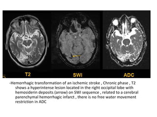 -Hemorrhagic transformation of an ischemic stroke , Chronic phase , T2
shows a hyperintense lesion located in the right occipital lobe with
hemosiderin deposits (arrow) on SWI sequence , related to a cerebral
parenchymal hemorrhagic infarct , there is no free water movement
restriction in ADC
 