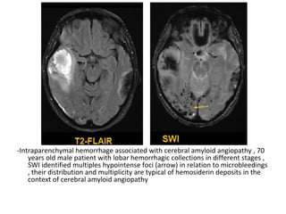 -Intraparenchymal hemorrhage associated with cerebral amyloid angiopathy , 70
years old male patient with lobar hemorrhagic collections in different stages ,
SWI identified multiples hypointense foci (arrow) in relation to microbleedings
, their distribution and multiplicity are typical of hemosiderin deposits in the
context of cerebral amyloid angiopathy
 