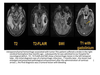 -Intraparenchymal hemorrhage associated with tumor This patient suffered a stroke in the right
cerebral hemisphere few months ago , subsequently he was admitted to our hospital for
neurological deficit , T2 , T2 FLAIR and SWI show a hemorrhagic lesion in the left temporal
lobe , the initial diagnosis was of a hemorrhagic infarction , 7 months later , this lesion had
enlarged and presented pathological enhancement after the administration of contrast (
arrow ) , the final diagnosis was a tumoral lesion with bleeding
 