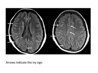 Arrows indicate the ivy sign
 