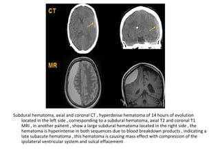 Subdural hematoma, axial and coronal CT , hyperdense hematoma of 14 hours of evolution
located in the left side , corresponding to a subdural hematoma, axial T2 and coronal T1
MRI , in another patient , show a large subdural hematoma located in the right side , the
hematoma is hyperintense in both sequences due to blood breakdown products , indicating a
late subacute hematoma , this hematoma is causing mass effect with compression of the
ipsilateral ventricular system and sulcal effacement
 