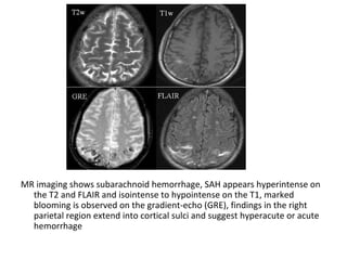 MR imaging shows subarachnoid hemorrhage, SAH appears hyperintense on
the T2 and FLAIR and isointense to hypointense on the T1, marked
blooming is observed on the gradient-echo (GRE), findings in the right
parietal region extend into cortical sulci and suggest hyperacute or acute
hemorrhage
 