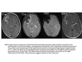 MRI images show an extensive subarachnoid hemorrhage along the right cerebral convexity most
prominently in the frontal region, also depicted are edema in the underlying cerebral parenchyma ,
mass effect and compression of the right lateral ventricle, the hemorrhage appears hyperintense
on T1 , with low signal on T2 and blooming on gradient-echo (GRE), the vasogenic edema appears
hyperintense on T2 and GRE, TOF MRA shows a partially thrombotic aneurysm at the right
trifurcation of the MCA , these features suggest rupture of the aneurysm
 