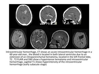 Intraventricular hemorrhage, CT shows an acute intraventricular hemorrhage in a
60 year-old man , the blood is located in both lateral ventricles due to an
extension of an intraparenchymal hematoma, located in the left frontal lobe,
T2 , T2 FLAIR and SWI show a hypointense hematoma and intraventricular
hemorrhage, sagittal T1 shows hyperintensity of the intraventricular
hemorrhage (early subacute stage)
 