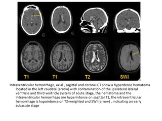 Intraventricular hemorrhage, axial , sagittal and coronal CT show a hyperdense hematoma
located in the left caudate (arrow) with contamination of the ipsilateral lateral
ventricle and third ventricle system of acute stage, the hematoma and the
intraventricular hemorrhage are hyperintense on sagittal T1, the intraventricular
hemorrhage is hypointense on T2-weighted and SWI (arrow) , indicating an early
subacute stage
 