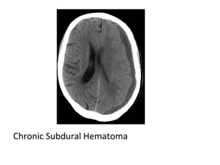 Chronic Subdural Hematoma
 