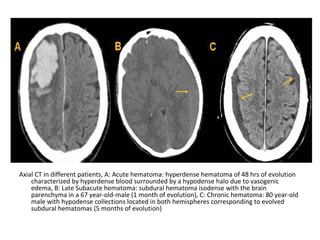 Axial CT in different patients, A: Acute hematoma: hyperdense hematoma of 48 hrs of evolution
characterized by hyperdense blood surrounded by a hypodense halo due to vasogenic
edema, B: Late Subacute hematoma: subdural hematoma isodense with the brain
parenchyma in a 67 year-old-male (1 month of evolution), C: Chronic hematoma: 80 year-old
male with hypodense collections located in both hemispheres corresponding to evolved
subdural hematomas (5 months of evolution)
 