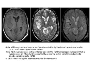 -Axial MR images show a hyperacute hematoma in the right external capsule and insular
cortex in a known hypertensive patient
-Axial T1 shows isointense to hypointense lesion in the right temporoparietal region that is
hyperintense on T2 and with susceptibility appearing as low signal intensity due to
blood on gradient-echo (GRE)
-A small rim of vasogenic edema surrounds the hematoma
 