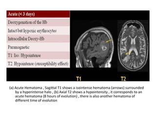 (a) Acute Hematoma , Sagittal T1 shows a isointense hematoma (arrows) surrounded
by a hyperintense halo , (b) Axial T2 shows a hypointensity , it corresponds to an
acute hematoma (8 hours of evolution) , there is also another hematoma of
different time of evolution
 