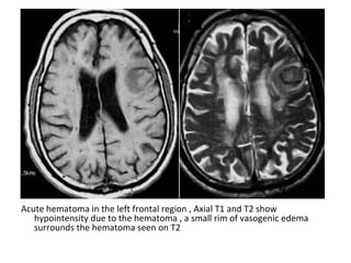 Acute hematoma in the left frontal region , Axial T1 and T2 show
hypointensity due to the hematoma , a small rim of vasogenic edema
surrounds the hematoma seen on T2
 