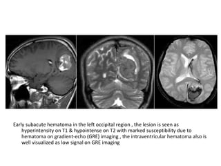 Early subacute hematoma in the left occipital region , the lesion is seen as
hyperintensity on T1 & hypointense on T2 with marked susceptibility due to
hematoma on gradient-echo (GRE) imaging , the intraventricular hematoma also is
well visualized as low signal on GRE imaging
 