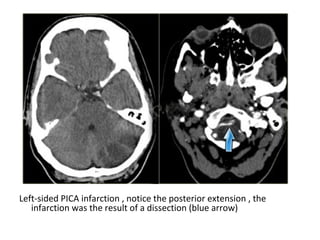 Left-sided PICA infarction , notice the posterior extension , the
infarction was the result of a dissection (blue arrow)
 