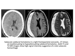 Subacute subdural hematoma in a right frontoparietal concavity , CT shows
an isoattenuating to hypoattenuating subdural hematoma , both T1 and
T2 MR images show high signal intensity suggestive of a late subacute
hemorrhage
 