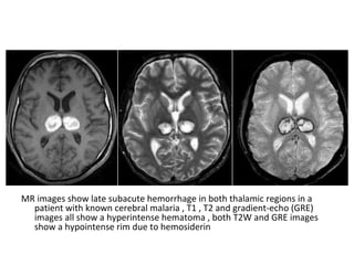 MR images show late subacute hemorrhage in both thalamic regions in a
patient with known cerebral malaria , T1 , T2 and gradient-echo (GRE)
images all show a hyperintense hematoma , both T2W and GRE images
show a hypointense rim due to hemosiderin
 