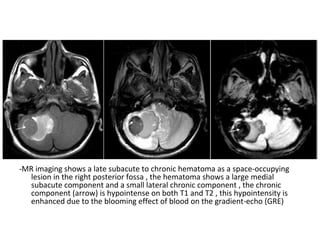 -MR imaging shows a late subacute to chronic hematoma as a space-occupying
lesion in the right posterior fossa , the hematoma shows a large medial
subacute component and a small lateral chronic component , the chronic
component (arrow) is hypointense on both T1 and T2 , this hypointensity is
enhanced due to the blooming effect of blood on the gradient-echo (GRE)
 