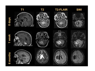 Diagnostic Imaging of Stroke