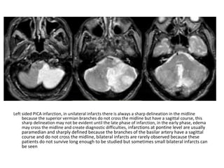 Left sided PICA infarction, in unilateral infarcts there is always a sharp delineation in the midline
because the superior vermian branches do not cross the midline but have a sagittal course, this
sharp delineation may not be evident until the late phase of infarction, in the early phase, edema
may cross the midline and create diagnostic difficulties, infarctions at pontine level are usually
paramedian and sharply defined because the branches of the basilar artery have a sagittal
course and do not cross the midline, bilateral infarcts are rarely observed because these
patients do not survive long enough to be studied but sometimes small bilateral infarcts can
be seen
 