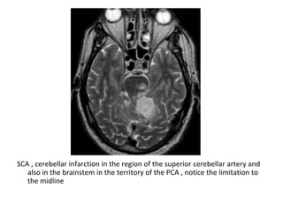SCA , cerebellar infarction in the region of the superior cerebellar artery and
also in the brainstem in the territory of the PCA , notice the limitation to
the midline
 
