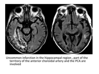 Uncommon infarction in the hippocampal region , part of the
territory of the anterior choroidal artery and the PCA are
involved
 