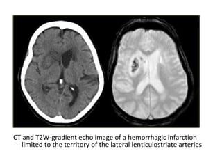 CT and T2W-gradient echo image of a hemorrhagic infarction
limited to the territory of the lateral lenticulostriate arteries
 