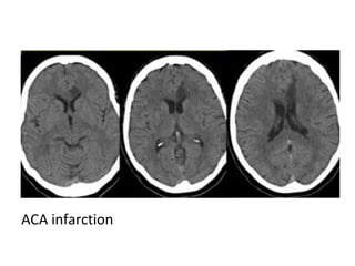 ACA infarction
 